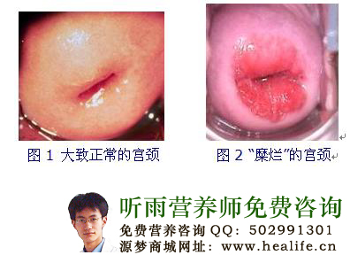 宫颈糜烂是怎么形成的?如何调理?
