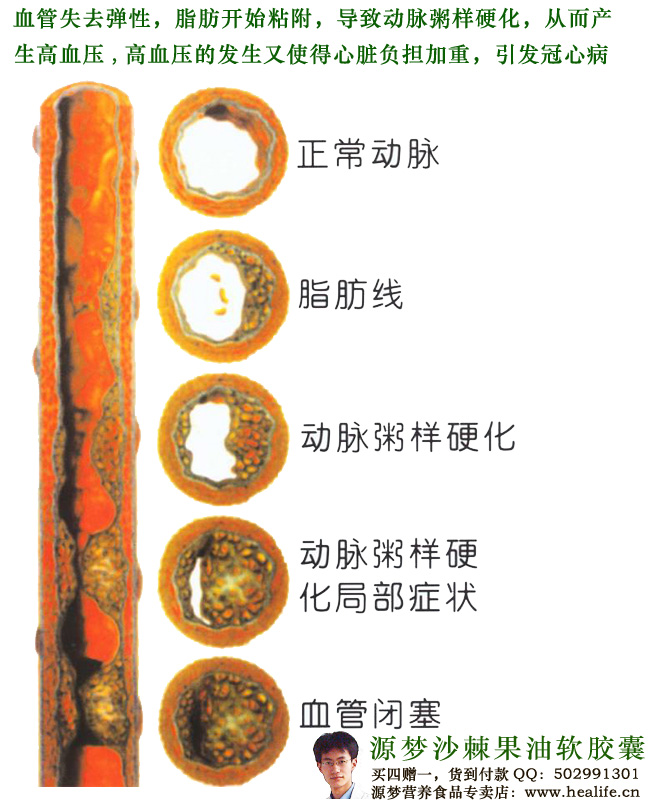 动脉粥样硬化