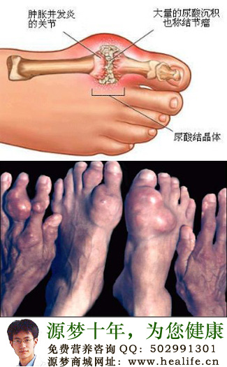 关节炎要补的五种营养要素