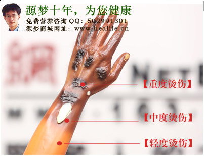 烫伤的分类