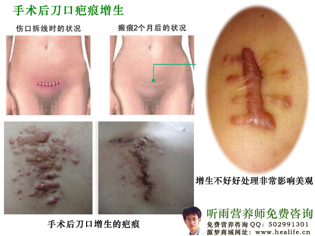 手术后刀口疤痕增生,如果不好好处理,非常影响皮肤美观