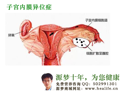 子宫内膜异位症