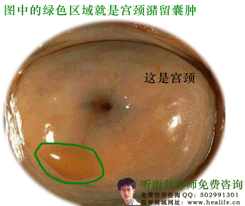 图中的绿色区域就是宫颈潴留囊肿