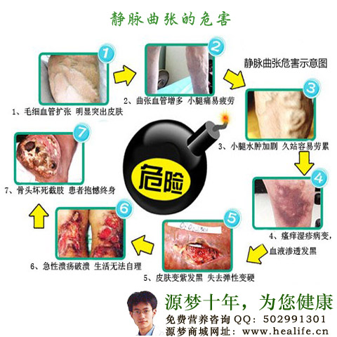 静脉曲张怎么调理?