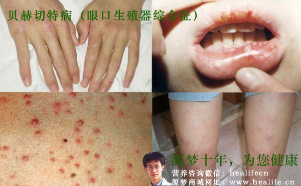 贝赫切特病(眼口生殖器综合征)