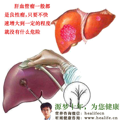 肝血管瘤一般都是良性瘤