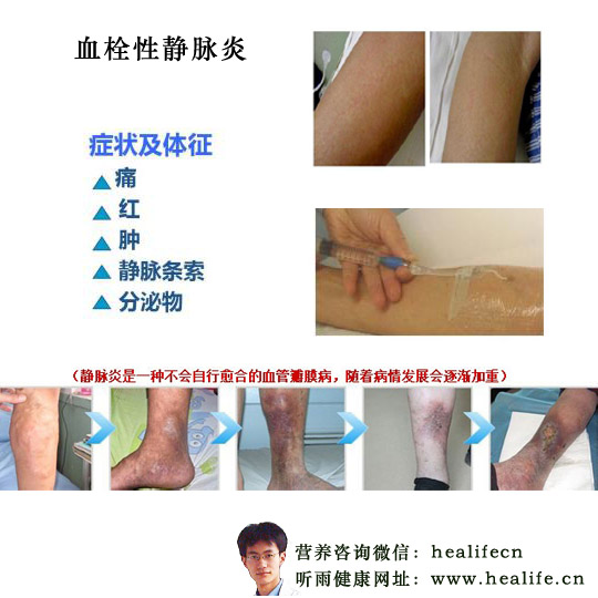 血栓性静脉炎