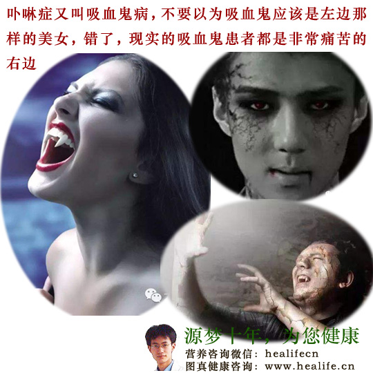 卟啉症