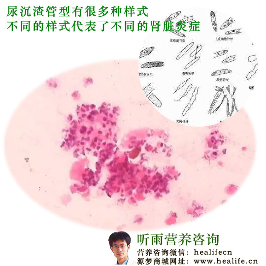 尿沉渣管型
