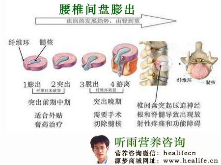 腰椎间盘膨出