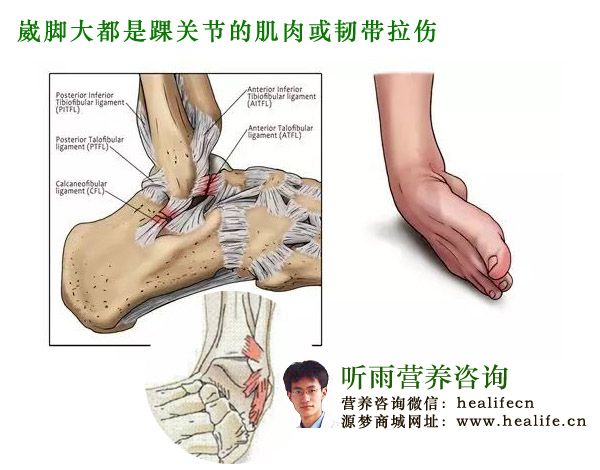 崴脚大都是踝关节的肌肉或韧带拉伤