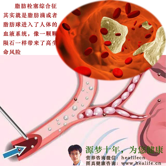 脂肪栓塞综合征