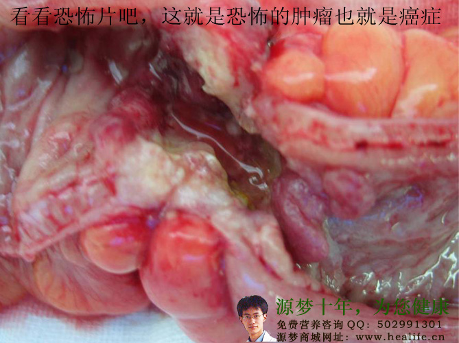 这就是恐怖的肿瘤也就是癌症