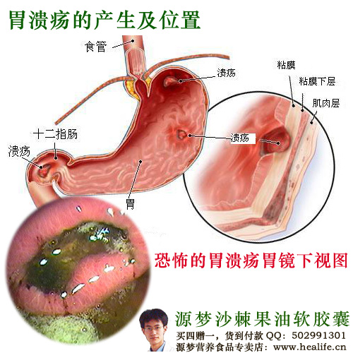 胃溃疡的产生及位置
