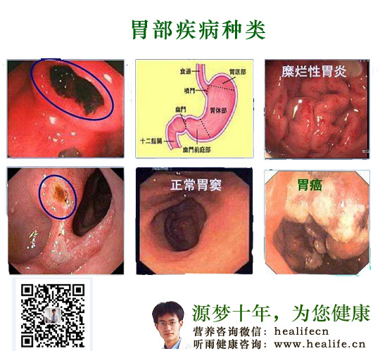 胃部疾病种类