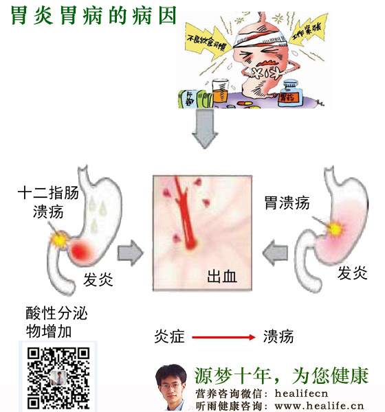 胃食管反流病