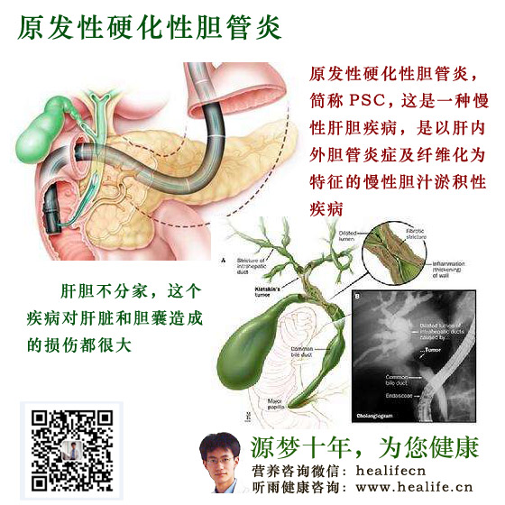 原发性硬化性胆管炎
