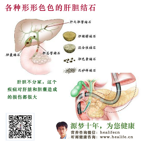 各种形形色色的肝胆结石