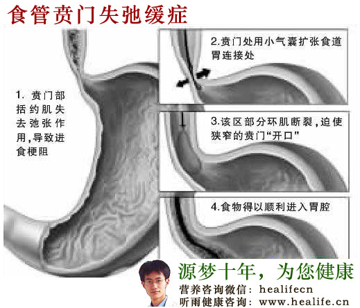 食管贲门失弛缓症的常见症状