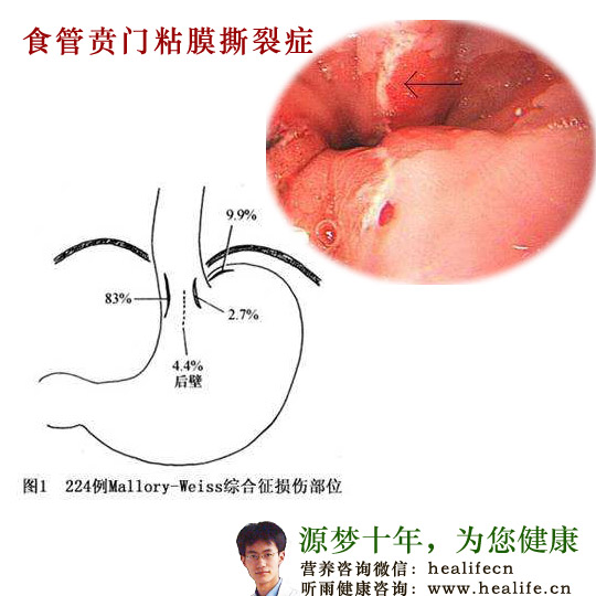 食管贲门粘膜撕裂症