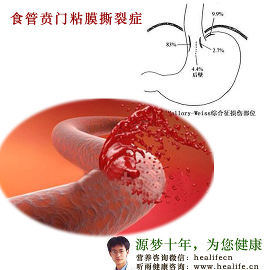 食管贲门粘膜撕裂症的常见症状