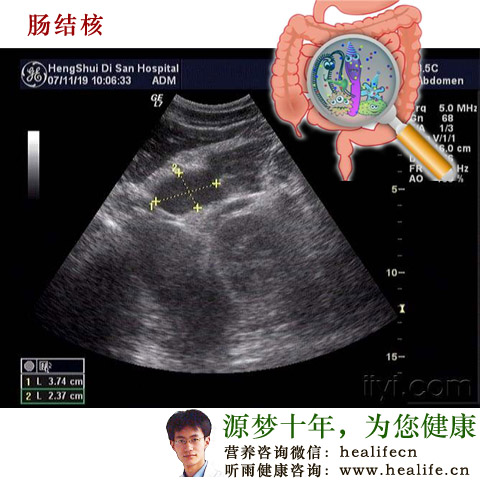 肠结核