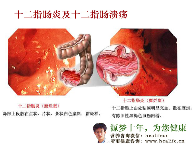 十二指肠炎及十二指肠溃疡