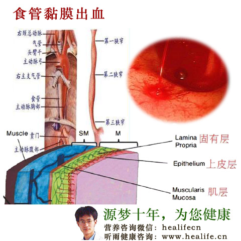 食管黏膜出血