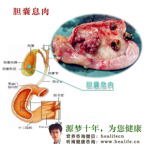 胆囊息肉