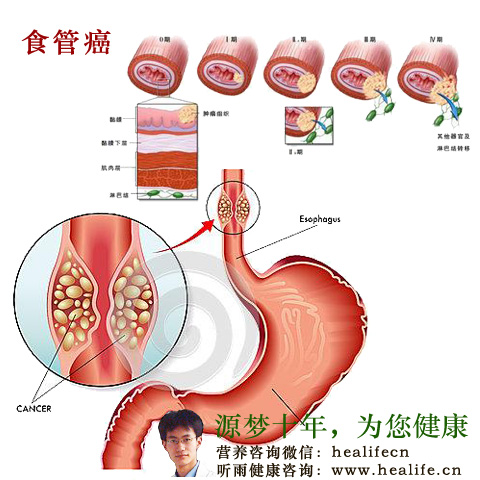 食管癌