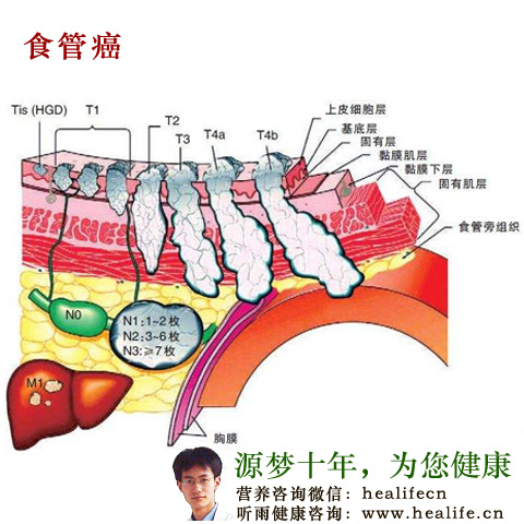 食管癌的临床症状