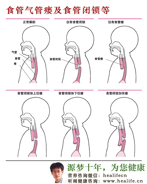 食管气管瘘