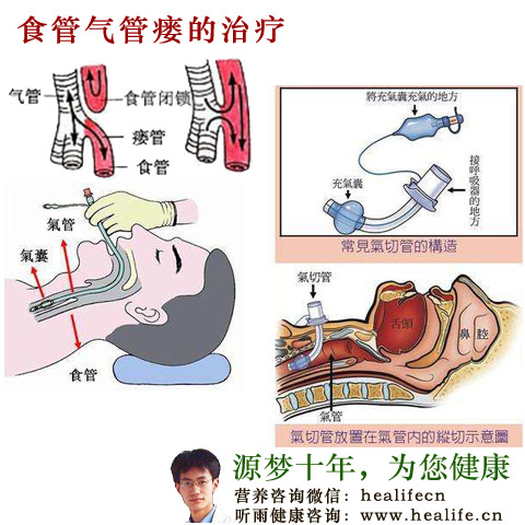 食管气管瘘的治疗