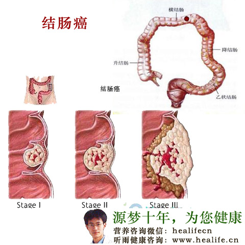 结肠癌的临床症状