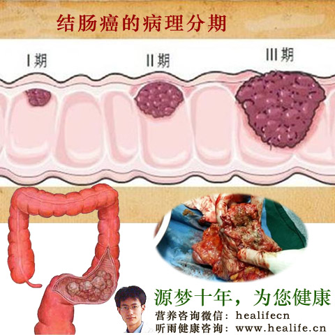 结肠癌的病理分期