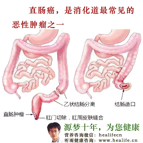 直肠癌的临床症状