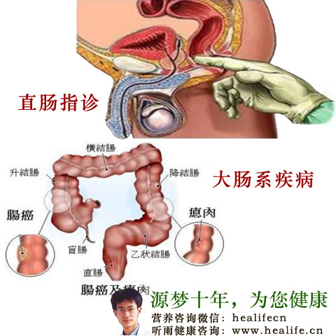 直肠指诊
