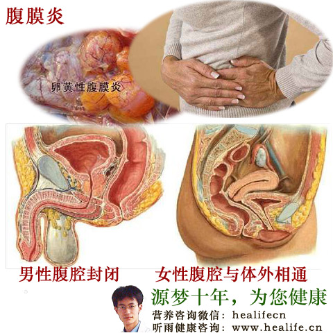 腹膜炎