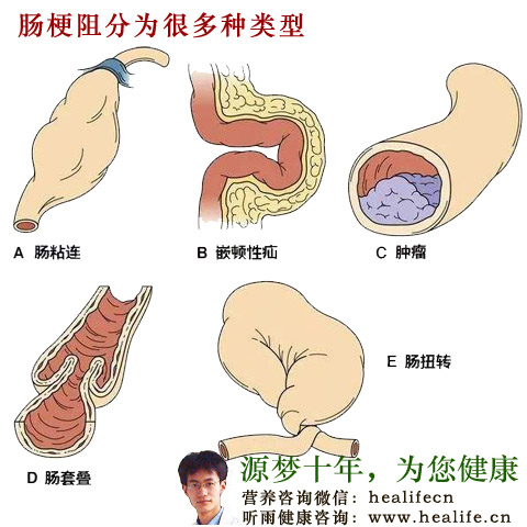 肠根阻分为很多种类型