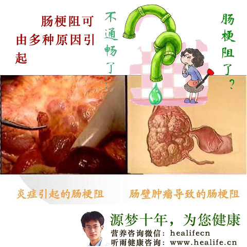 肠梗阻可由多种原因引起