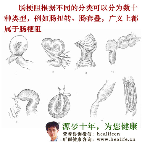 肠梗阻的分类