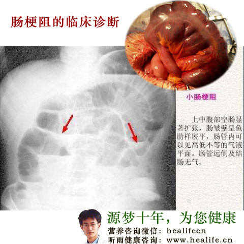 肠梗阻的临床诊断