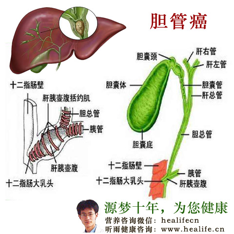 胆管癌