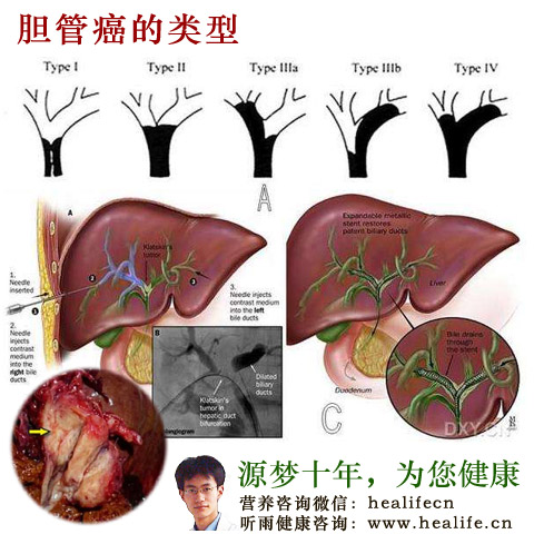 胆管癌的临床症状