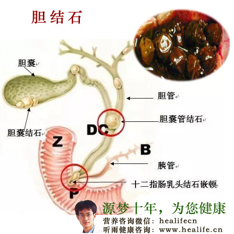 胆结石