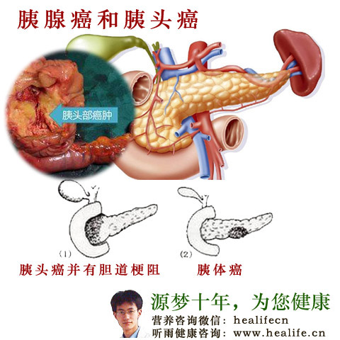胰腺癌和胰头癌