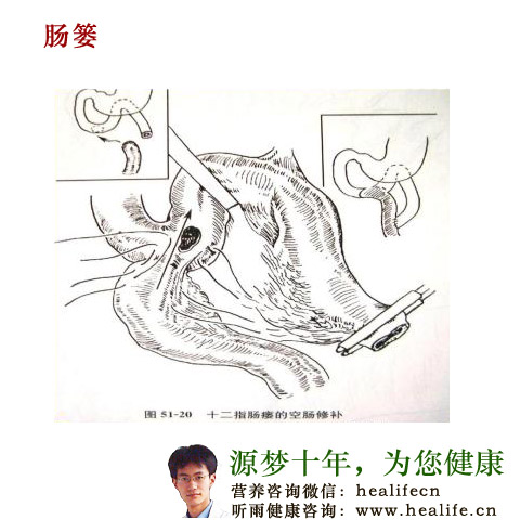 肠篓