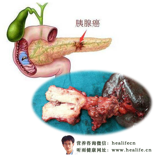 胰腺癌
