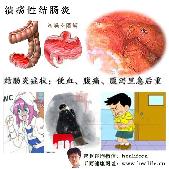 溃疡性结肠炎
