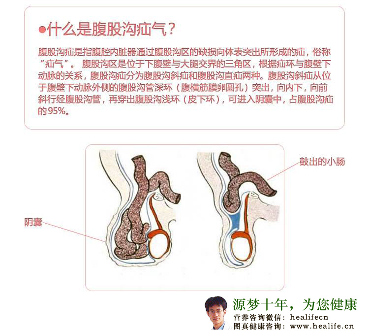 腹股沟疝